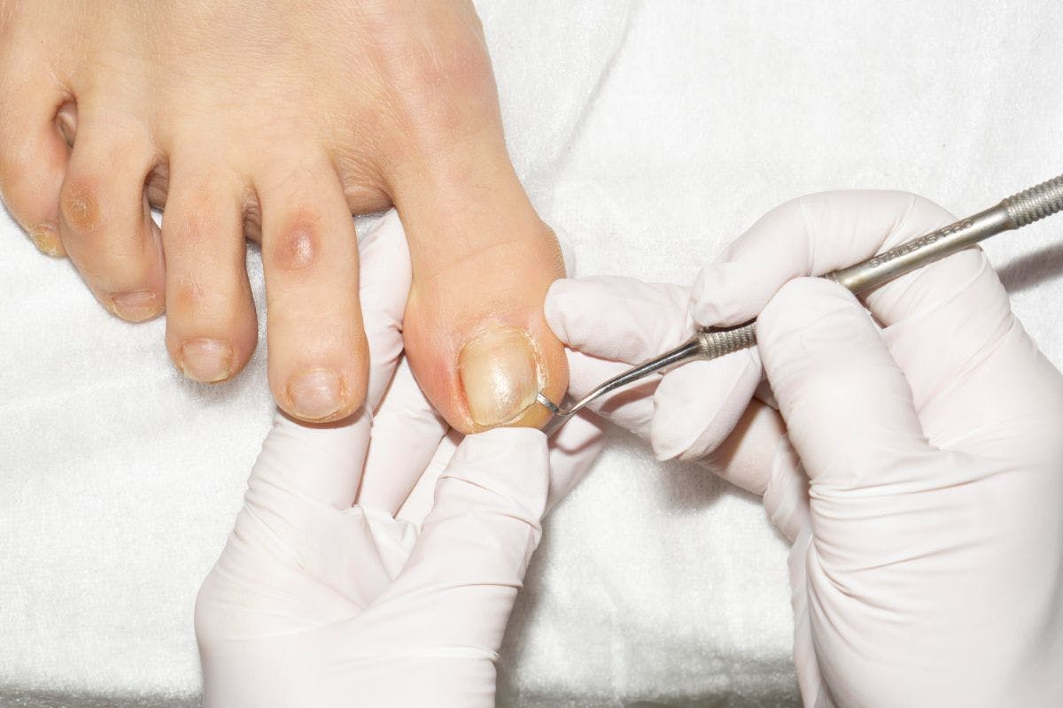 Основні причини вростання нігтів, оніхокриптоз