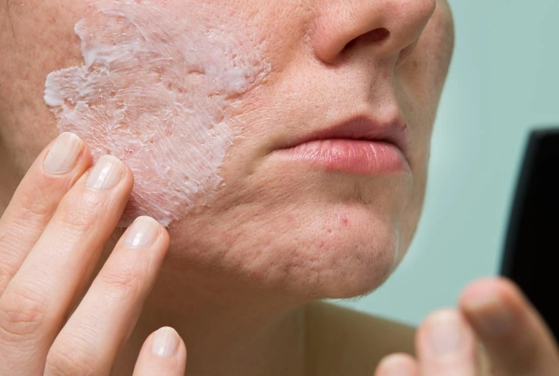 Чому L'Oréal відкликає з продажу La Roche-Posay Effaclar Duo з бензоїл пероксидом